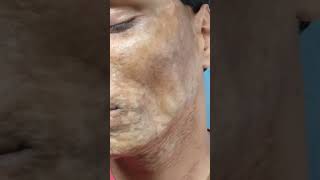 Morphea  Scleroderma  एक साधारण बीमारी भी इलाज के अभाव में काफी ख़तरनाक रूप ले सकती है  morphea [upl. by Neeneg]