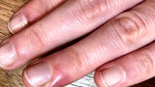 What is PARONYCHIA  Finger nail infection  Solve Paronychia with these simple Home Remedies [upl. by Htrow]