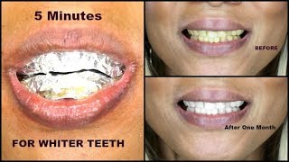 HOW TO GET REALLY WHITE TEETH  DIY TEETH WHITENING  Khichi Beauty [upl. by Devin612]