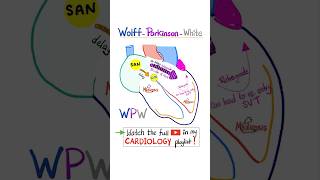 Cardiac Arrhythmia WolffParkinson White WPW Syndrome science cardio nurse doctor mbbs [upl. by Seana393]