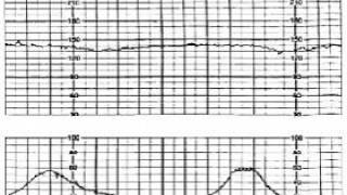 16 Intrapartum Fetal Monitoring [upl. by Rezal17]