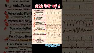 ECG Report  How To Read ECG  Abnormal ECG  Normal ECG 10millionviews trending ytshorts [upl. by Delp342]