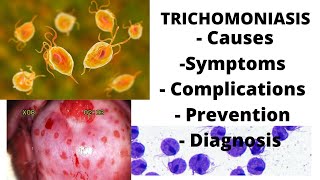 Trichomoniasis  symptoms causes complications prevention amp diagnosis [upl. by Suhploda]