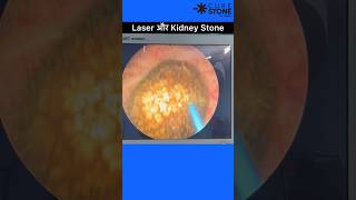 Kidney stone treatment using laser  RIRS  Retrograde intrarenal surgery shorts [upl. by Odnomyar]