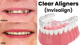 Clear Aligners Invisalign Price in Pakistan  Invisible Braces  Guide By Dr Shahzad Mirza [upl. by Reaht]