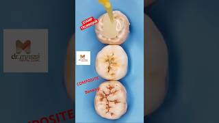 STAMP Technique for Composite direct fillings [upl. by Oreste832]