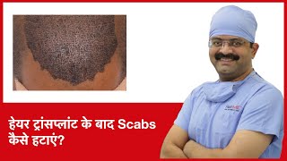 How To Remove Scabs After Hair Transplant हेयर ट्रांसप्लांट के बाद scabs कैसे हटाएं  HairMD Pune [upl. by Iatnwahs]