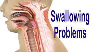 Swallowing Problems or Dysphagia Top 4 Possible Causes Including Cricopharyngeal Dysfunction CPD [upl. by Atiz345]