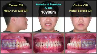 Skeletal Class III with posterior crossbite｜【Chris Chang Ortho】CC749 [upl. by Lenrad]