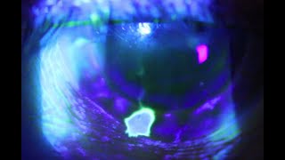 A positive Seidels Test or the corneal waterfall sign [upl. by Lseil]