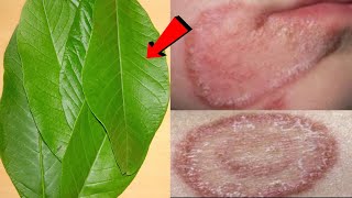 दाद खाज खुजली कितना भी सालों पुराना हो 3 दिन में छुट्टी कर देगा  fungal ringworm treatment [upl. by Hollinger]