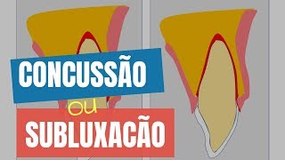 QUAL A DIFERENÇA ENTRE CONCUSSÃO E SUBLUXAÇÃO  QUICK TIP ENDOLOVERS [upl. by Adnolohs649]