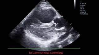 Pulmonary Embolism  Echo Clip [upl. by Hinkel]