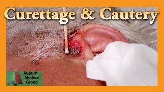 Curettage and Cautery for Basal Cell Carcinoma  Auburn Medical Group [upl. by Niret657]