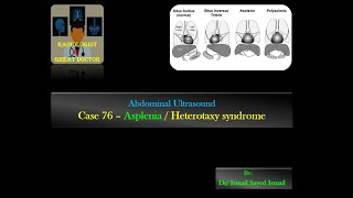 Ultrasound Case 76 Asplenia  Heterotaxy Syndrome [upl. by Corabel]