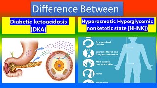 Diabetic ketoacidosis DKA Vs Hyperosmotic Hyperglycemic nonketotic state  HHNK [upl. by Eladnor]