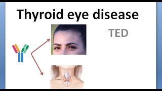 Ophthalmology 423 Thyroid Eye Disease Graves Exophthalmos Proptosis NOSPECS Classification Cause [upl. by Elie]