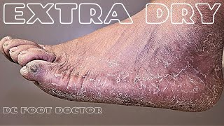 Extra Dry Calluses Dry Skin Athletes Feet and Exfoliation [upl. by Meece47]