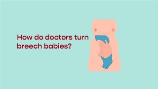 How do Doctors turn Breech babies [upl. by Anetta753]