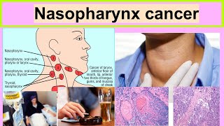 nasopharynx cancer [upl. by Euphemiah133]