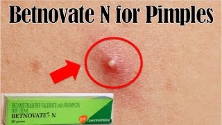 How to use Betnovate N for pimples  Remove pimples overnight remedy [upl. by Morville]