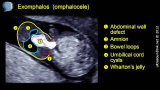 Omphalocele exomphalos [upl. by Ennaylil]