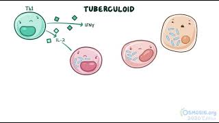 Mycobacterium Leprae  Leprosy  Osmosis [upl. by Tessil1]