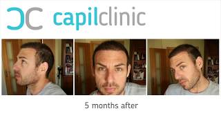 Hair Transplant in Turkey  Capilclinic  Real results [upl. by Steere254]