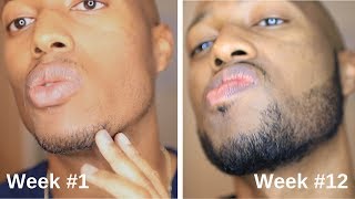 Minoxidil Beard Journey 3 Month Transformation [upl. by Elazaro]