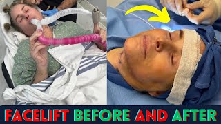 Shocking Facelift Before During amp After Neck Lift  facelift surgery before and after [upl. by Sana]