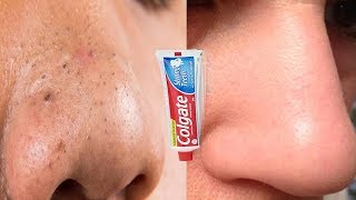 How to remove blackheads from nose using toothpaste [upl. by Dloreg]