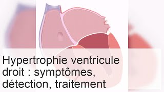 Causes et diagnostic de lhypertrophie du ventricule droit [upl. by Bordy591]