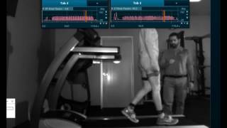 Quadriceps Avoidance Walking Gait Analysis [upl. by Eural]