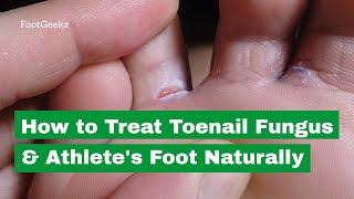 How to Treat Toenail Fungus amp Athletes Foot Naturally [upl. by Aribold272]