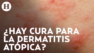 Dermatitis atópica Qué la causa cuáles son los síntomas y qué tratamientos hay  Médico H [upl. by Onairot163]