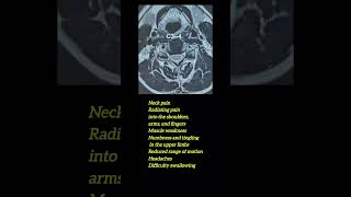 Prolapsed Intervertebral Disk PIVD at the C5C6 [upl. by Peckham]