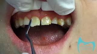 Composite Veneers  Full procedure [upl. by Neelrac156]