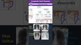 Segmental Analysis Approach to Congenital Heart Diseases [upl. by Attelrahc365]