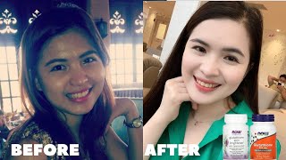 GLUTATHIONE BEFORE AND AFTER How to whiten skin [upl. by Annaihs75]