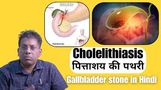 Cholelithiasis  पित्ताशय की पथरी  लक्षण कारण और उपचार  Gallbladder stone in Hindi [upl. by Leroi]