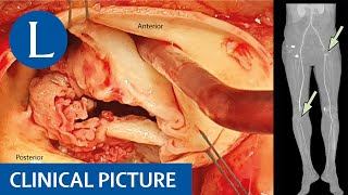 Antiphospholipid syndrome following Q fever [upl. by Letniuq]