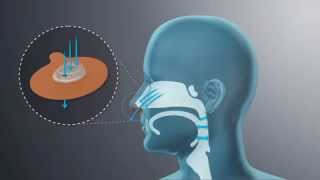 Provent Therapy An Alternative to CPAP for Sleep Apnea  DirectHomeMedicalcom [upl. by Oringa]