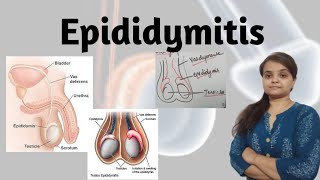 Epididymitis [upl. by Kaliope377]