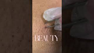 Ingrown Hair Removal [upl. by Abisia550]