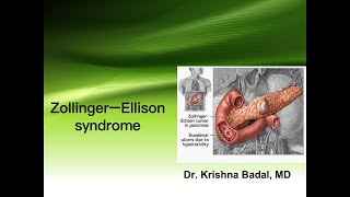 Zollinger Ellison syndrome [upl. by Emyam]