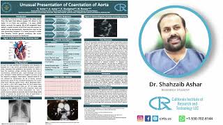 Unusual Presentation of Coarctation of Aorta  Dr Shahzaib Ashar [upl. by Lorsung]