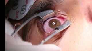 Corneal Iontophoresis Procedure [upl. by Morel]