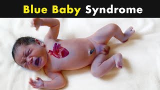 Cyanosis  Blue Skin Color in babies  Symptoms Causes and Treatment UrduHindi [upl. by Kordula748]