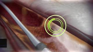 Coronary Orbital Atherectomy Long video [upl. by Yras]