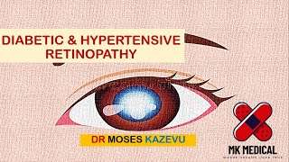 Diabetic amp Hypertensive retinopathy [upl. by Murtagh640]